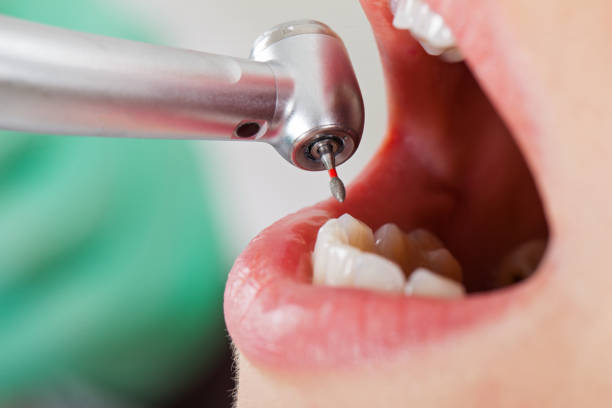 Best Emergency Wisdom Tooth Extraction in Houma, LA